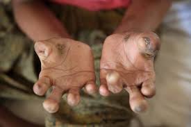 Leprosy Is Curable but Stigma Still Shapes the Global Health
