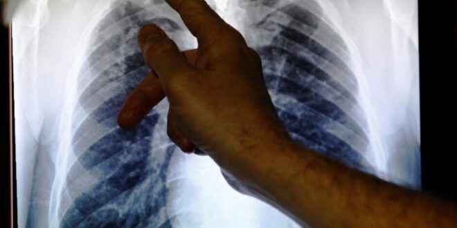 Experts urge community action to combat tuberculosis in SA